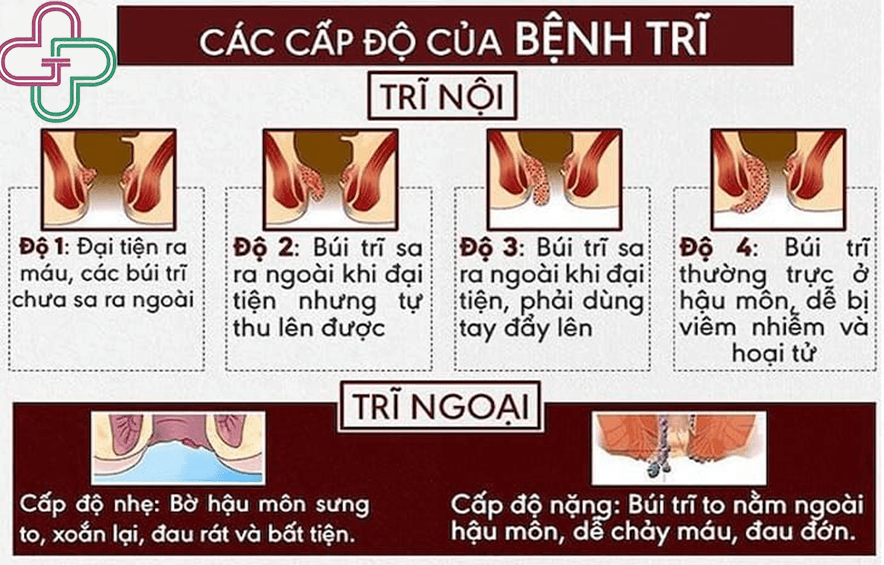 các cấp độ của bệnh trĩ