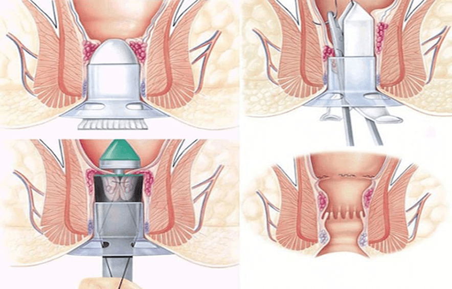 điều trị bệnh trĩ bằng phẫu thuật
