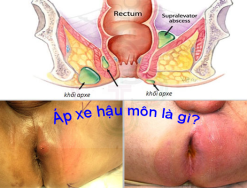 Giải đáp: Bệnh áp xe hậu môn là gì - áp xe hậu môn có chữa được không?