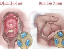 Giải đáp: Bệnh lậu là gì - nguyên nhân - triệu chứng và cách phòng tránh