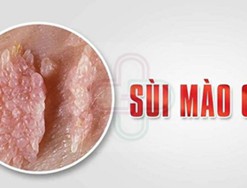 Giải đáp: Bệnh sùi mào gà là gì - nguyên nhân và dấu hiệu nhận biết