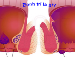 Giải đáp: Bệnh trĩ là gì?