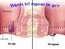 Giải đáp: Bệnh trĩ ngoại là gì?