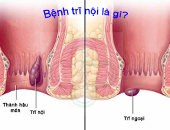 Giải đáp: Bệnh trĩ nội là gì? Nguyên nhân và cách phòng tránh