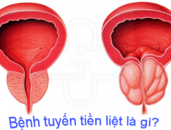 Giải đáp: Bệnh ở tuyến tiền liệt là gì?