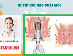 Bệnh nhân bị trĩ - khi nào phải mổ?