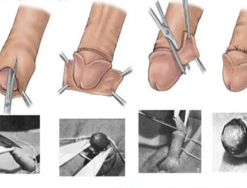 Các phương pháp phẫu thuật cắt bao quy đầu cho nam giới là gì?