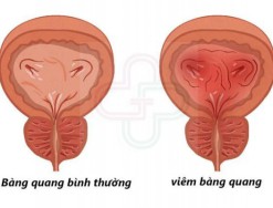 Giải đáp: Bệnh viêm bàng quang là gì? Có chữa được viêm bàng quang không?