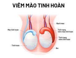 Giải đáp: Bệnh viêm mào tinh hoàn là gì? Có nguy hiểm không?