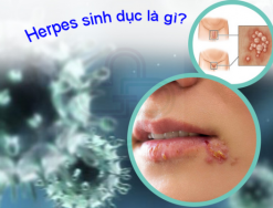 Giải đáp : Herpes sinh dục là gì  - nguyên nhân dấu hiệu và cách điều trị