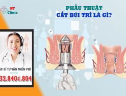 Phẫu thuật cắt búi trĩ là gì - các lưu ý sau khi cắt trĩ