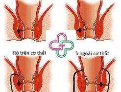 Giải đáp: Bệnh rò hậu môn là gì? Có nguy hiểm không?