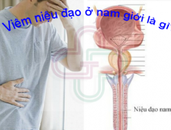 Giải đáp: Viêm niệu đạo ở nam giới là gì - nguyên nhân và dấu hiệu